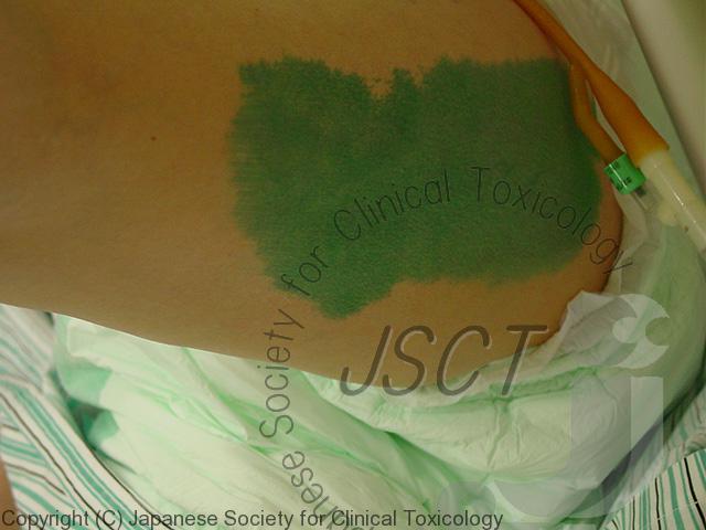 パラコート中毒の見通しはどうなりますか?